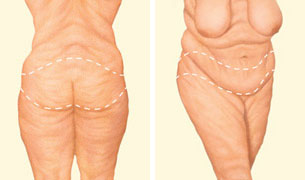 Lower body lift incision Lower body lift incision
