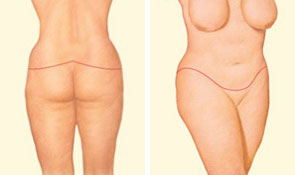 Body lift closing incision Body lift closing incision