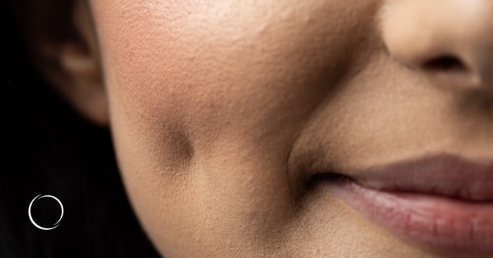 creating dimples with plastic surgery