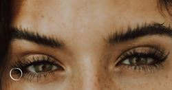 Scar-free eye lifts: The rise of subtle eye rejuvenation