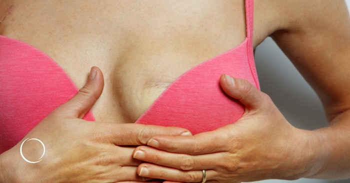 skin-sparing wise-pattern internal mammary perforator breast reconstruction