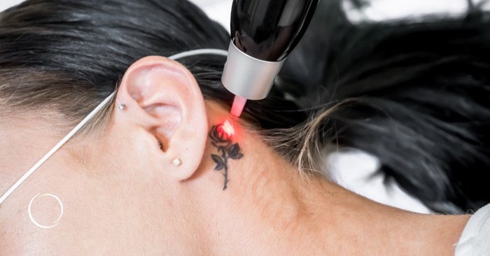 options for tattoo removal