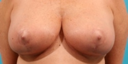 Dr. Steve Sample - Case XXXX - After